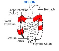 Crohn's Disease, Crohns and Colitis NZ